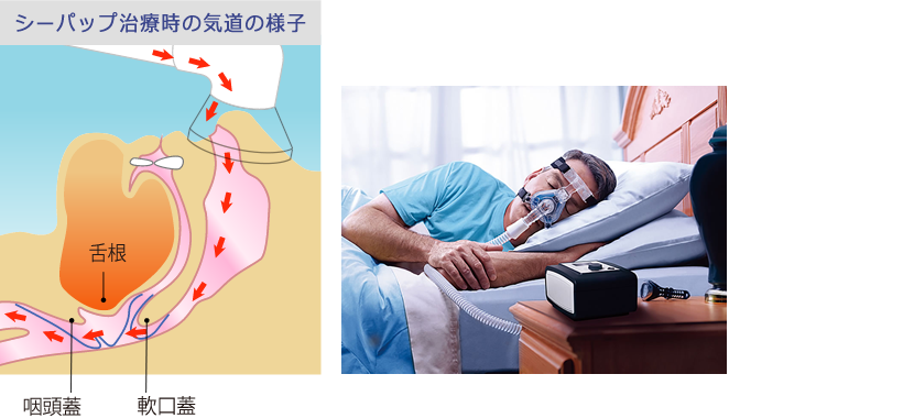 シーパップ治療は保険適用治療です
